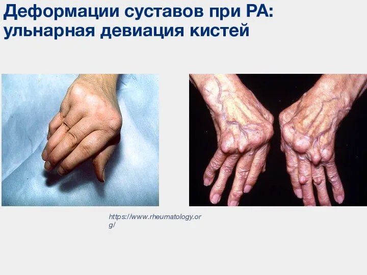 Деформации суставов при РА: ульнарная девиация кистей https://www.rheumatology.org/