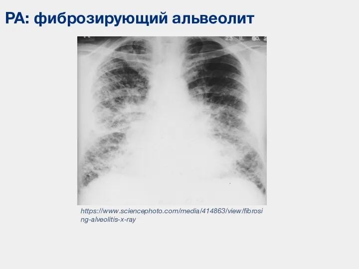 РА: фиброзирующий альвеолит https://www.sciencephoto.com/media/414863/view/fibrosing-alveolitis-x-ray