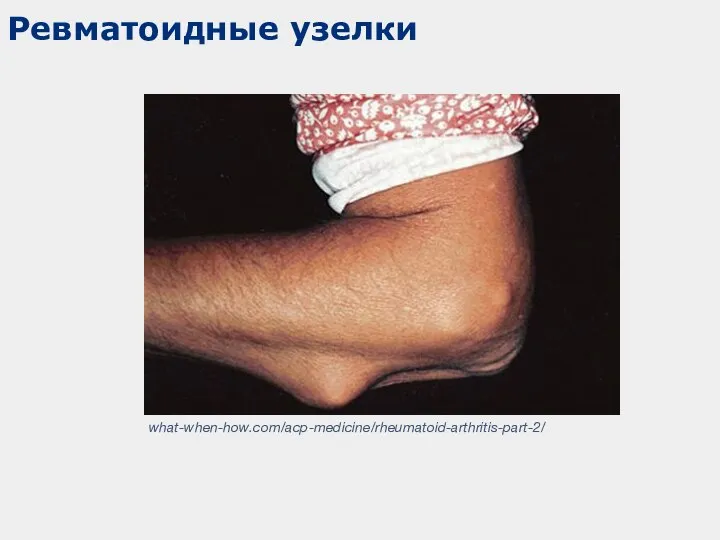 Ревматоидные узелки what-when-how.com/acp-medicine/rheumatoid-arthritis-part-2/