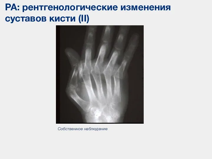РА: рентгенологические изменения суставов кисти (II) Собственное наблюдение