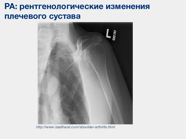 РА: рентгенологические изменения плечевого сустава http://www.izadihand.com/shoulder-arthritis.html