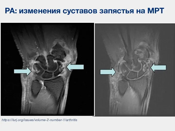 РА: изменения суставов запястья на МРТ https://lurj.org/issues/volume-2-number-1/arthritis