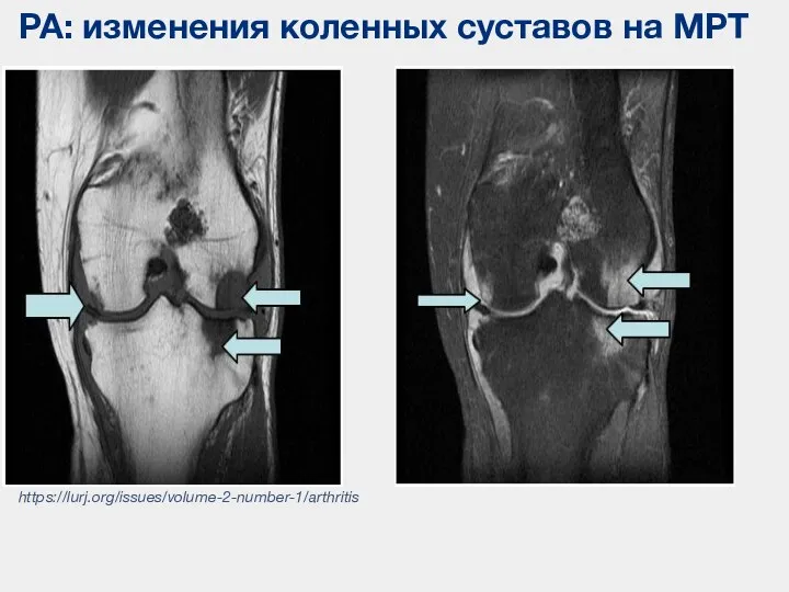 РА: изменения коленных суставов на МРТ https://lurj.org/issues/volume-2-number-1/arthritis