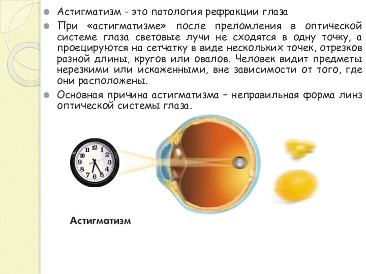 Астигматизм - это патология рефракции глаза При «астигматизме» после преломления в оптической