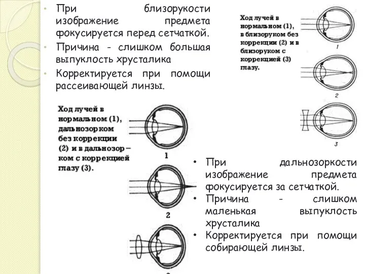 При близорукости изображение предмета фокусируется перед сетчаткой. Причина - слишком большая выпуклость