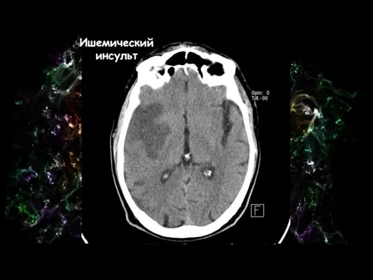 Ишемический инсульт