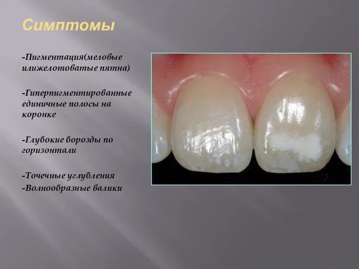 Симптомы -Пигментация(меловые илижелотоватые пятна) -Гиперпигментированные единичные полосы на коронке -Глубокие борозды по
