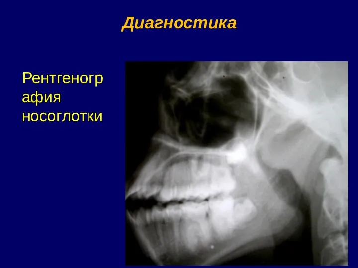Диагностика Рентгенография носоглотки