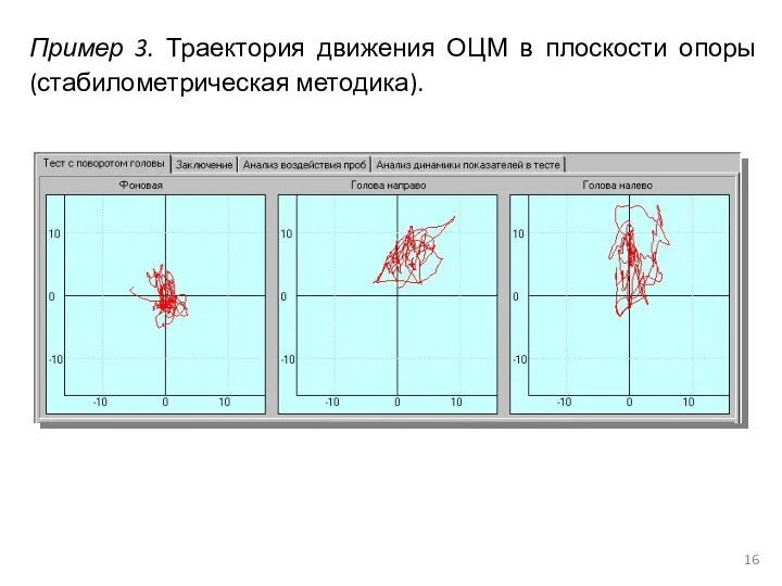 Пример 3. Траектория движения ОЦМ в плоскости опоры (стабилометрическая методика).