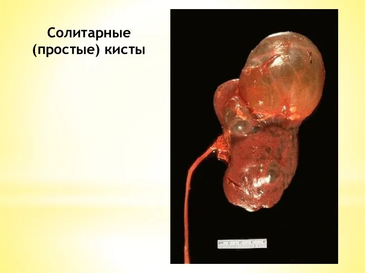 Солитарные (простые) кисты