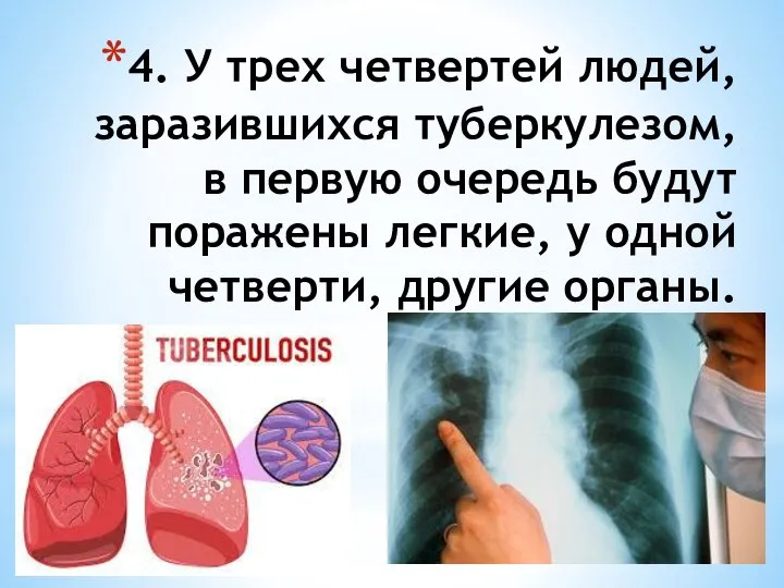 4. У трех четвертей людей, заразившихся туберкулезом, в первую очередь будут поражены