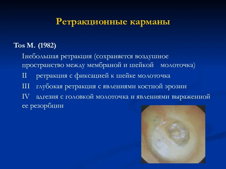 Ретракционные карманы Tos M. (1982) I небольшая ретракция (сохраняется воздушное пространство между