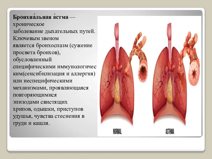 Бронхиа́льная а́стма — хроническое заболевание дыхательных путей. Ключевым звеном является бронхоспазм (сужение