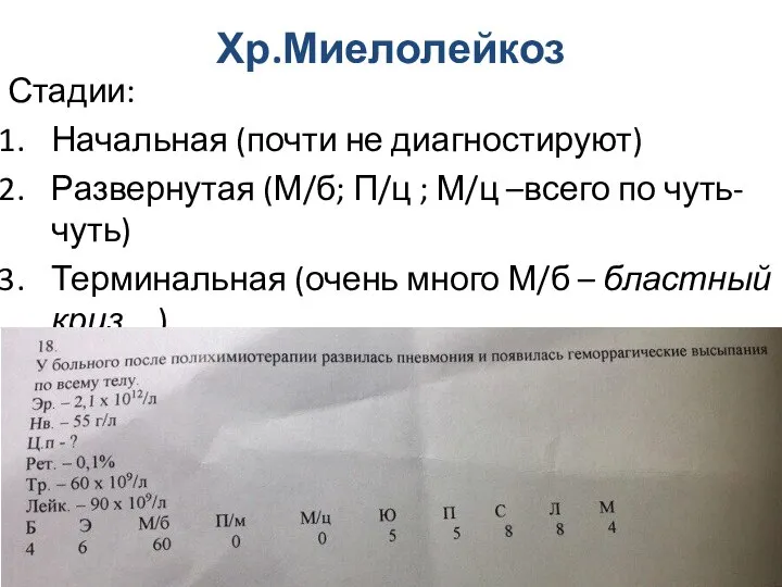 Хр.Миелолейкоз Стадии: Начальная (почти не диагностируют) Развернутая (М/б; П/ц ; М/ц –всего