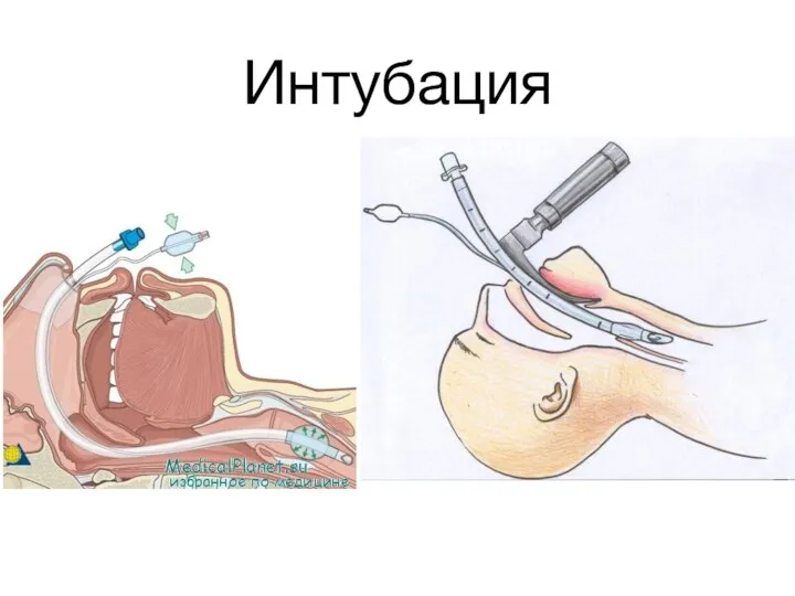 Интубация