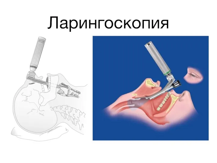 Ларингоскопия