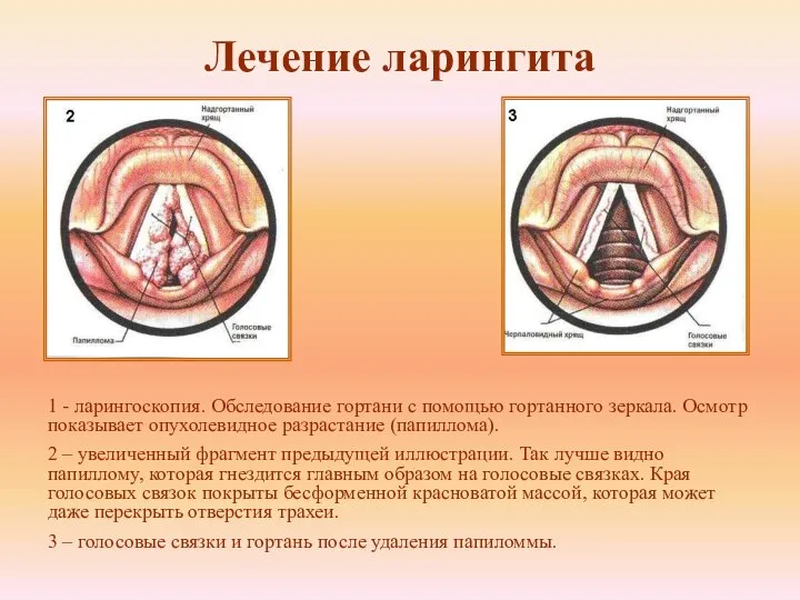 Лечение ларингита 1 - ларингоскопия. Обследование гортани с помощью гортанного зеркала. Осмотр