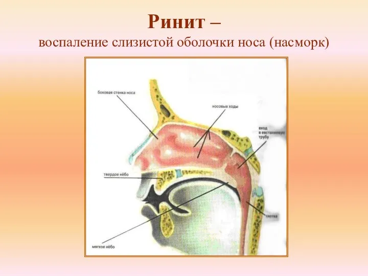 Ринит – воспаление слизистой оболочки носа (насморк)