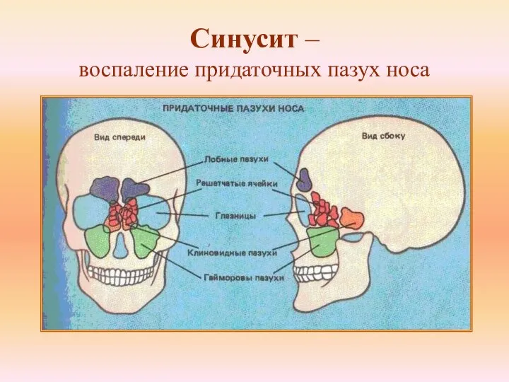 Синусит – воспаление придаточных пазух носа