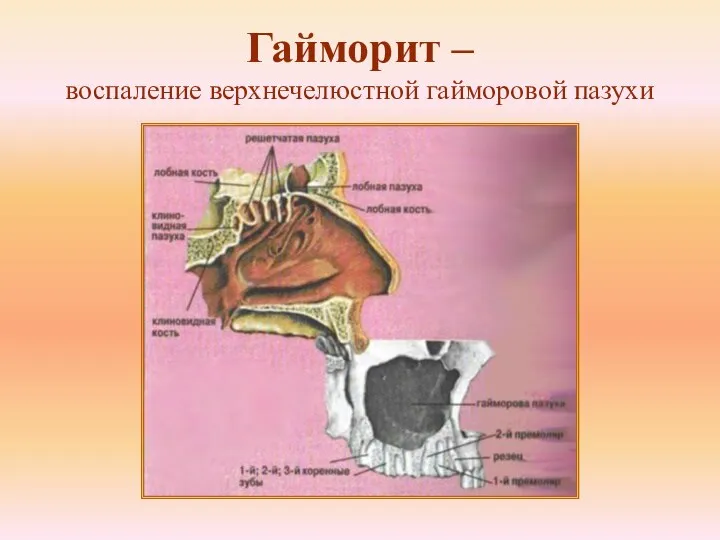 Гайморит – воспаление верхнечелюстной гайморовой пазухи