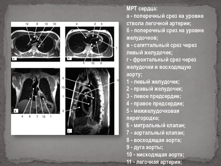 МРТ сердца: а - поперечный срез на уровне ствола легочной артерии; б
