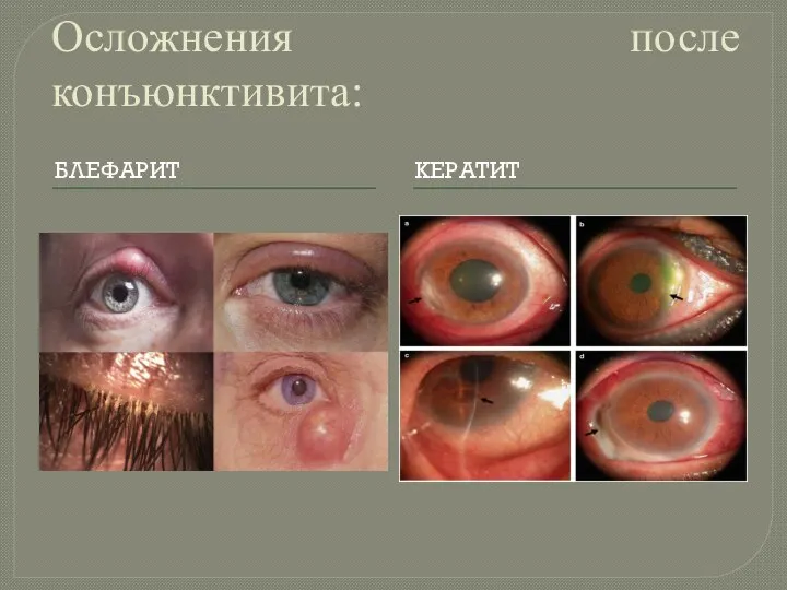 Осложнения после конъюнктивита: БЛЕФАРИТ КЕРАТИТ