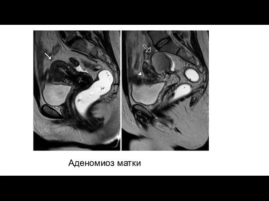 Аденомиоз матки