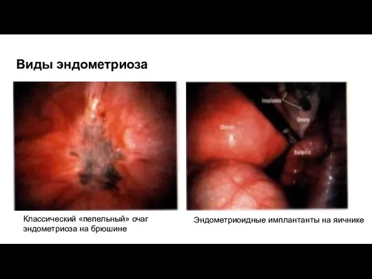Виды эндометриоза Классический «пепельный» очаг эндометриоза на брюшине Эндометриоидные имплантанты на яичнике