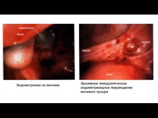 Эндометриома на яичнике Эрозивное геморрагическое эндометриоидное повреждение мочевого пузыря
