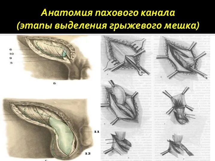 Анатомия пахового канала (этапы выделения грыжевого мешка)