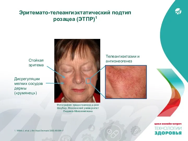 1. Wilkin J, et al. J Am Acad Dermatol 2002;46:584–7 Эритемато-телеангиэктатический подтип