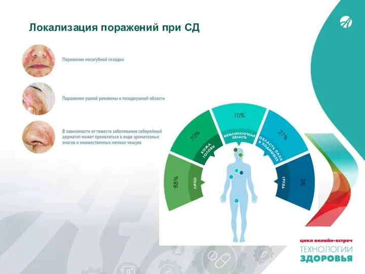 Локализация поражений при СД