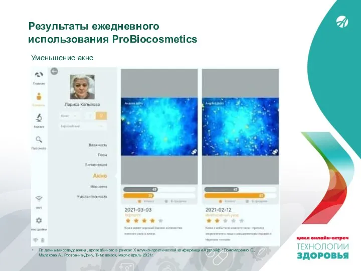 Результаты ежедневного использования ProBiocosmetics Уменьшение акне По данным исследования, проведённого в рамках