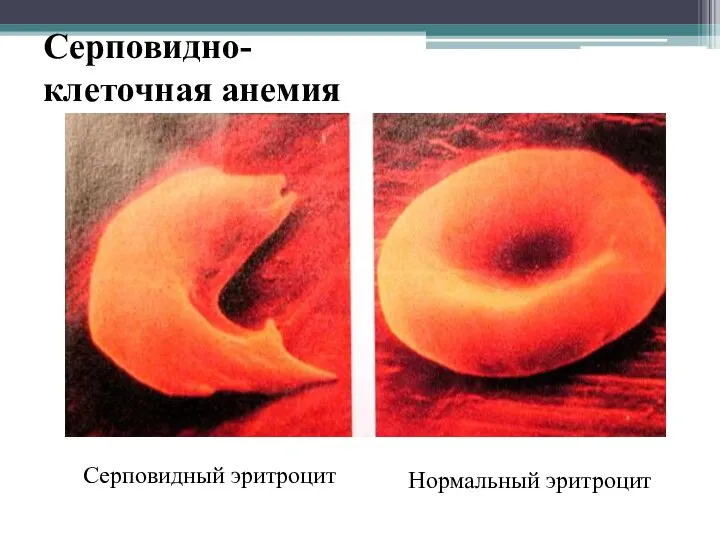 Серповидно-клеточная анемия Серповидный эритроцит Нормальный эритроцит