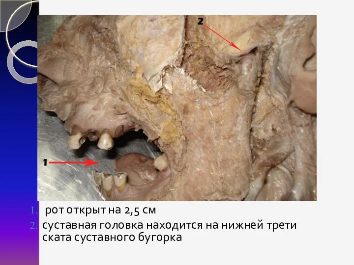 рот открыт на 2,5 см суставная головка находится на нижней трети ската суставного бугорка