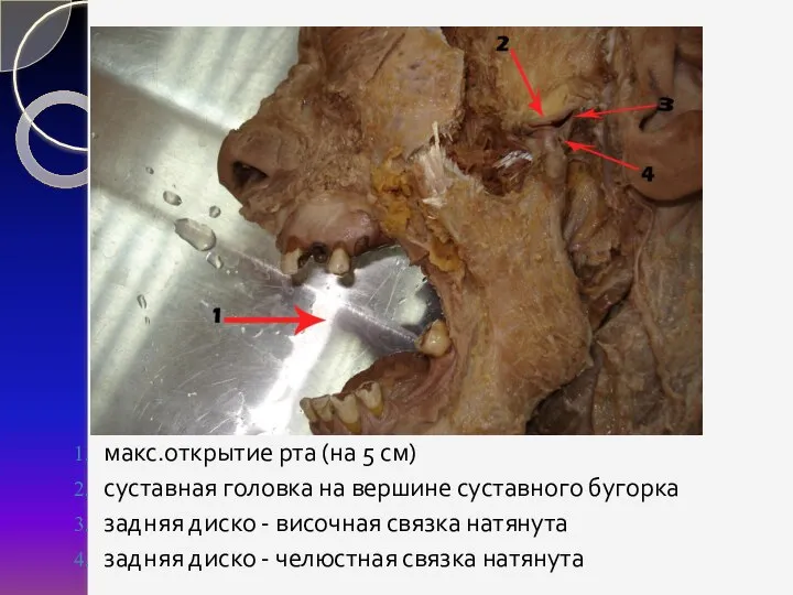 макс.открытие рта (на 5 см) суставная головка на вершине суставного бугорка задняя