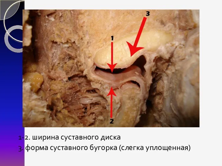 1-2. ширина суставного диска 3. форма суставного бугорка (слегка уплощенная)