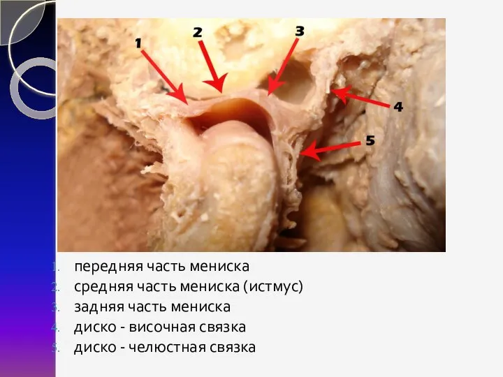 передняя часть мениска средняя часть мениска (истмус) задняя часть мениска диско -