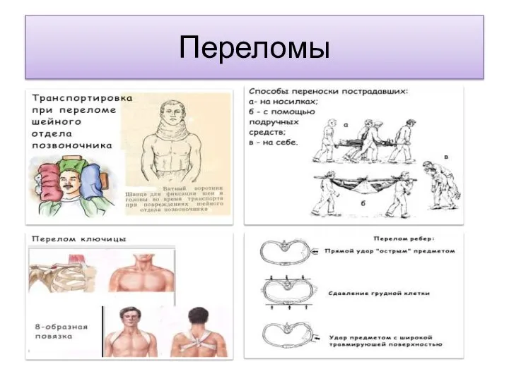 Переломы