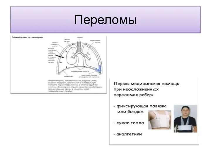 Переломы