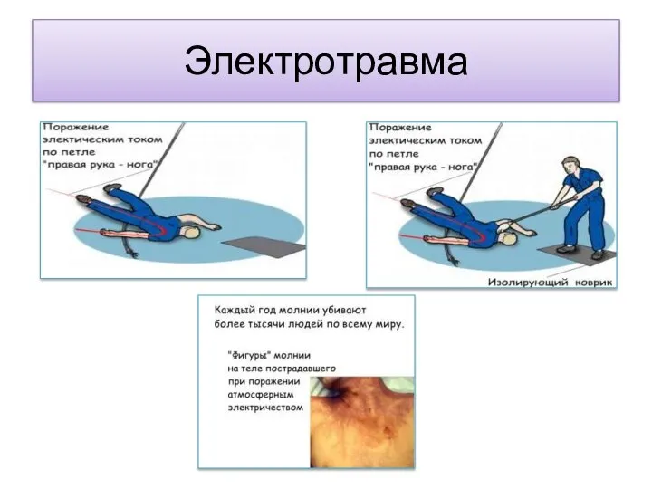 Электротравма