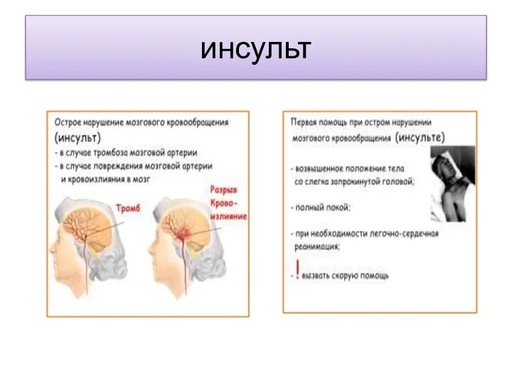 инсульт