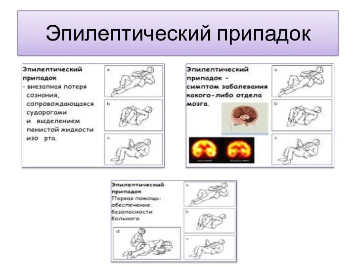 Эпилептический припадок