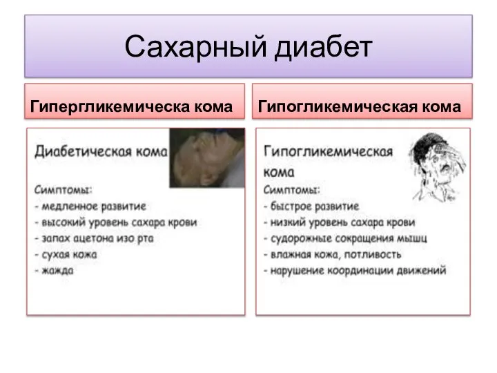 Сахарный диабет Гипергликемическа кома Гипогликемическая кома