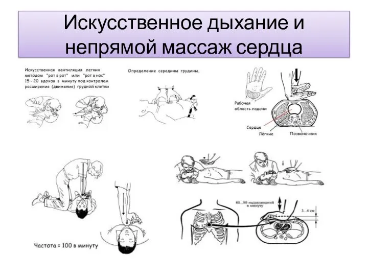 Искусственное дыхание и непрямой массаж сердца