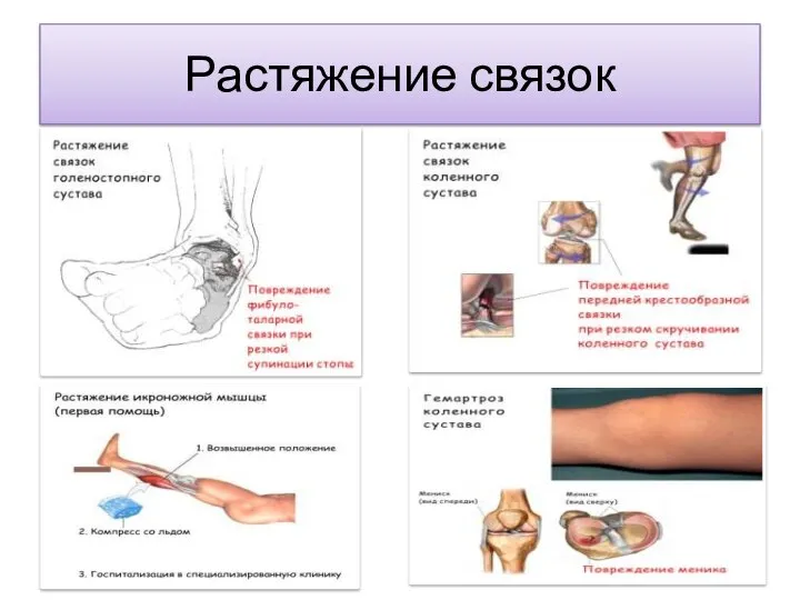 Растяжение связок