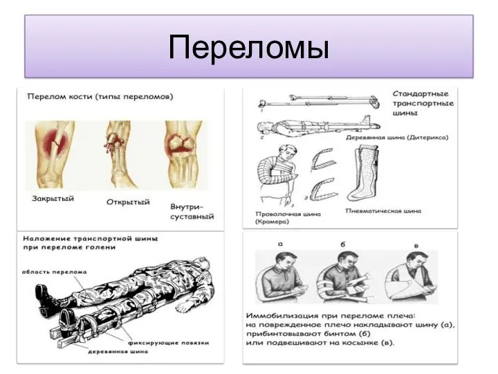 Переломы