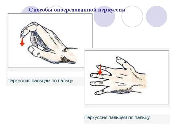 Способы опосредованной перкуссии