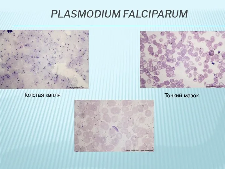 PLASMODIUM FALCIPARUM Толстая капля Тонкий мазок