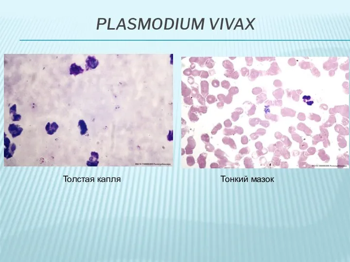 PLASMODIUM VIVAX Толстая капля Тонкий мазок